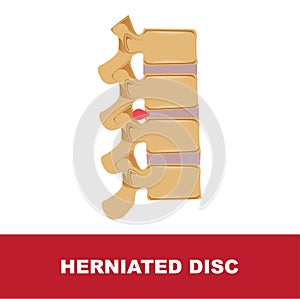 Herniated disc illustration
