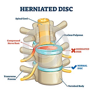 Herniated disc injury 3D side view on spine bone skeleton vector illustration