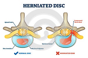 Herniated disc injury as labeled spinal pain explanation vector illustration