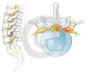 Desct de columna vertebral, él resbaló desct. médico ilustraciones 