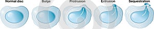 Herniated disc schema. Normal disc. Bulge. Protusion. Extrusion. Sequestration. Labeled illustration