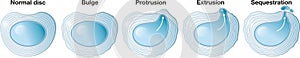 Herniated disc schema. Normal disc. Bulge. Protusion. Extrusion. Sequestration. Labeled illustration