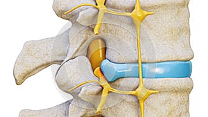 Herniated disc with spinal nerve compression 3D rendering illustration lateral view isolated on white background. Backbone or