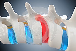 Herniated disk compresses the spinal cord