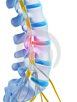 Herniated disk