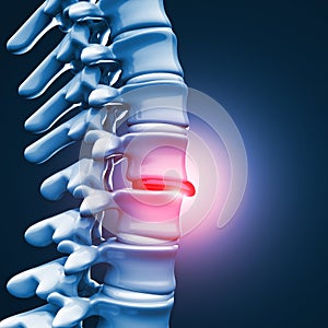 Herniated disk human spinal