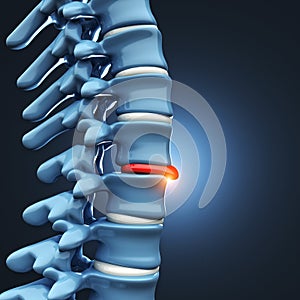 Herniated disk human spinal