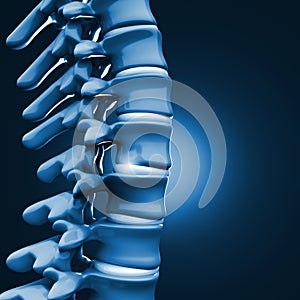 Herniated disk human spinal