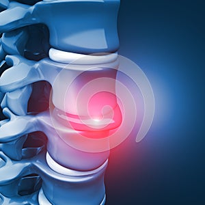 Herniated disk human spinal