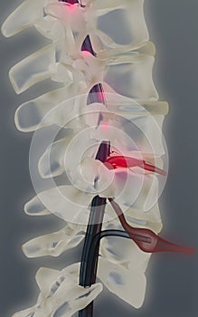 Herniated vertebral disk photo