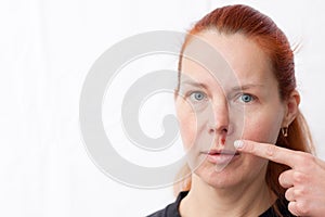 Herpes above upper lip in woman. portrait of middle aged woman with problem skin, on light background. woman pointing finger at