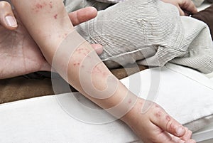 Herpes in a child arm.