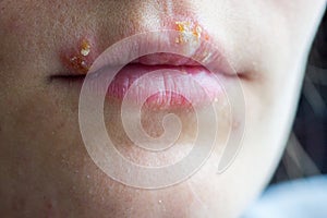 Herpes disease on the lips of a young girl