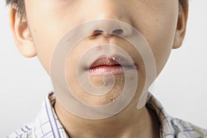 Herpes on kid mouth become dry