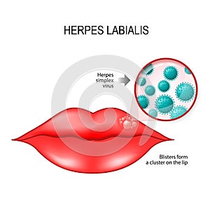 Herpes labialis on the lips photo