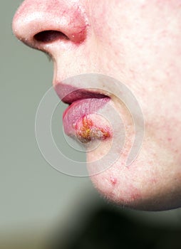 Herpes on lip