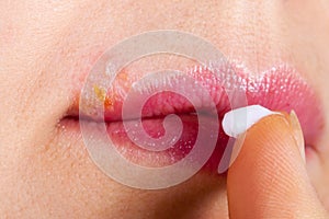 Herpes on the lip close-up macro. Woman lubricates the labial herpes ointment photo
