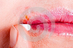 Herpes on the lip close-up macro. Woman lubricates the labial herpes ointment photo