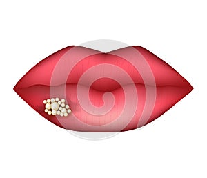 Herpes on the lip. Infographics. Vector illustration on isolated background.