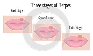 Herpes on the lips