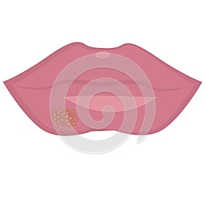 Herpes on lips cold sores viral infection photo