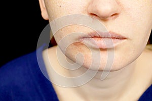 Herpes on the lips: a woman with a cold and the herpes is examined by a dermatologist and infectious disease specialist