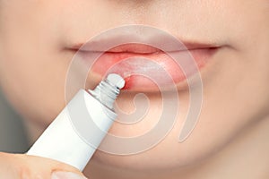 Herpes on the lips of the young woman . Woman lubricates the labial herpes ointment photo