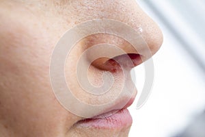 Herpes on the nose - Pretty caucasian woman with herpes her on nose, close-up. Human Virus