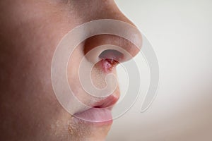 Herpes on the nose - Pretty young caucasian boy with herpes her on nose. Close-up. Human Virus