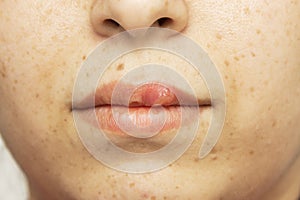 Herpes oral cold sore blisters on the lips- herpes simplex photo