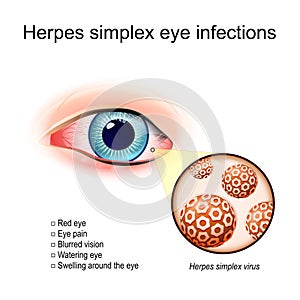 Herpes simplex eye infections. A red human`s eye photo