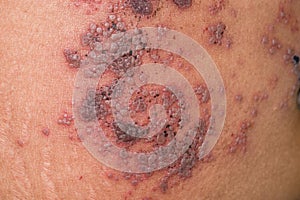 Herpes simplex infection at abdomen. Small and painful vesicles