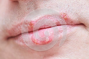 Herpes simplex virus infection on male face lips