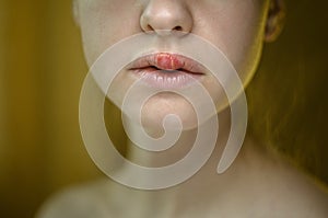 Herpes Simplex Virus on the Upper Lip of a Young Beautiful Woman.