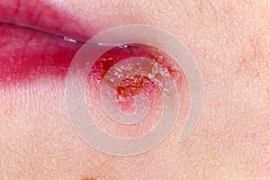 Herpes on the skin of the face child