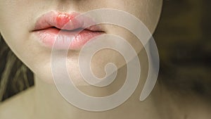 Herpes Simplex Virus on the Upper Lip of a Young Beautiful Woman. photo