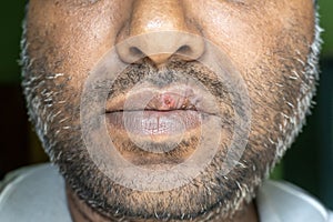 Herpes virus concept. A cold sore on the lip of a middle-aged male. Fever blisters
