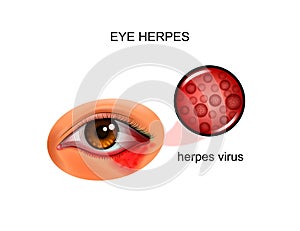 The herpes virus of the eye