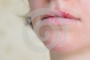 Herpes virus on female lips