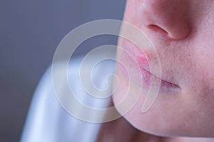 Herpes virus on human lips. Woman with herpes sore on lip mouth, closeup view.
