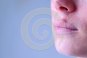 Herpes virus on human lips. Woman with herpes sore on lip mouth, closeup view. photo