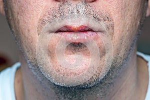 Herpes virus infection in a man on the lips