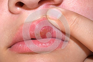 Herpes virus on the lip