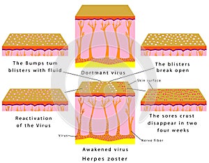 Herpes zoster photo