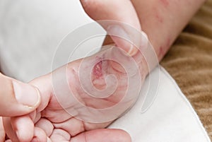 Herpes zoster in a child hand.