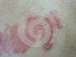 Herpes Zoster, Shingles are caused by a virus. varicella-zoster virus,