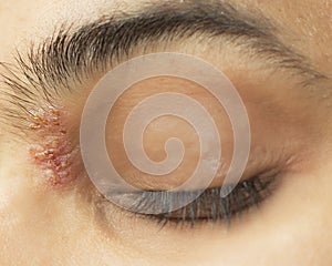 Herpetic eye disease - herpes zoster ophthalmicus photo