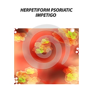 Herpetiform psoriatic impetigo. Eczema, dermatitis skin disease psoriasis. Infographics. Vector illustration on isolated