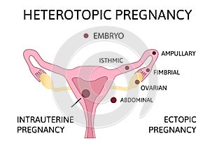 Heterotopic Pregnancy. extra-uterine ectopic pregnancy and intrauterine pregnancy occur simultaneously photo