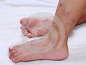 hfmd hand foot mouth virus red blisters on both legs and feet epidemic in sick children Painful red rash